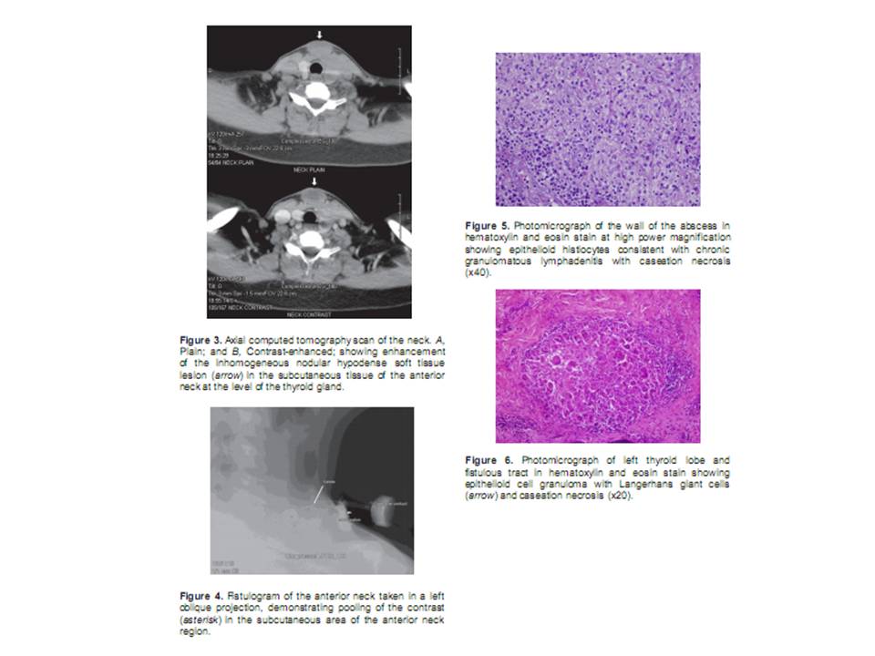 Tuberculosis - Symptoms and causes - Mayo Clinic
